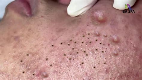 Her Instagram account is a little over two years old, but she has already amassed 2. . Highlight professional blackhead popping g spa